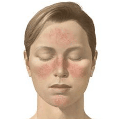 Rosacea