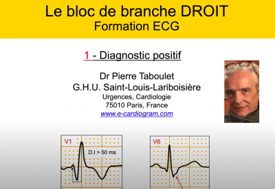 ECG -13