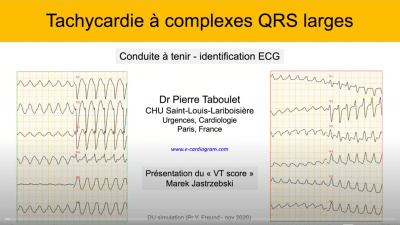 ECG -35