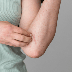 Le psoriasis