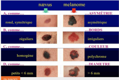 Naevus versus melanome
