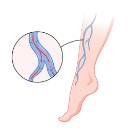 Phlébite / thrombose veineuse