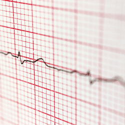 Insuffisance cardiaque